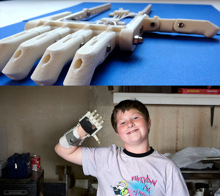 robohand-protez